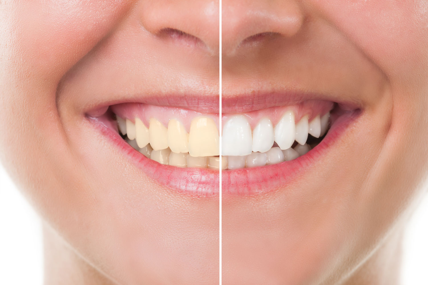 روکش تمام سرامیک