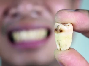 پوسیدگی دندان و عفونت سینوسی