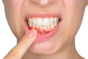 تاثیر مصرف آنتی بیوتیک ها بر عفونت دندان